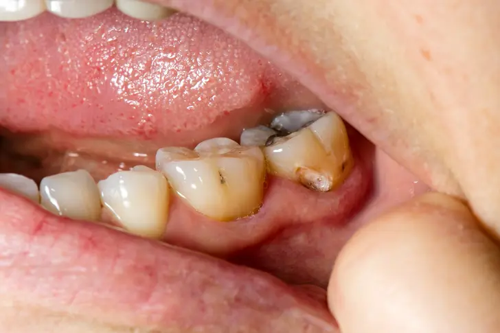 Tooth Abscess