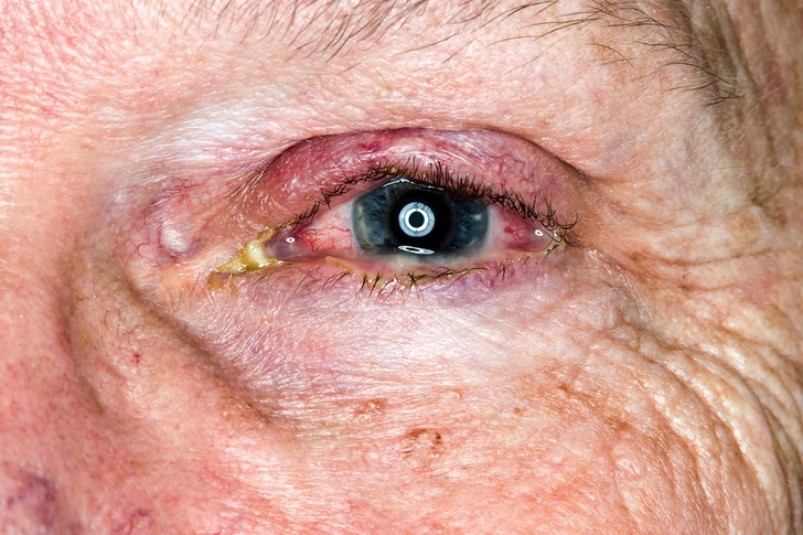 Pinkeye