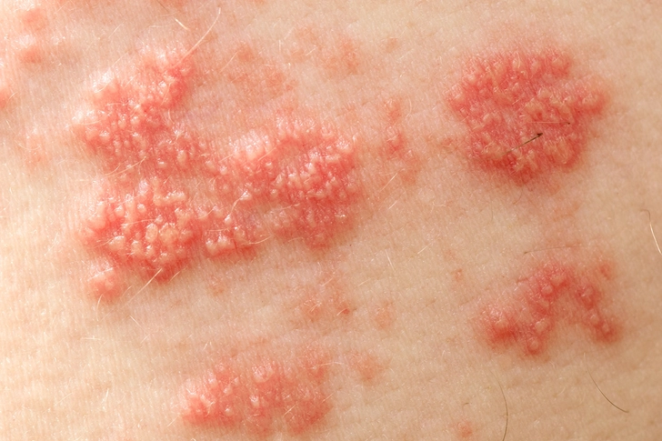 Shingles