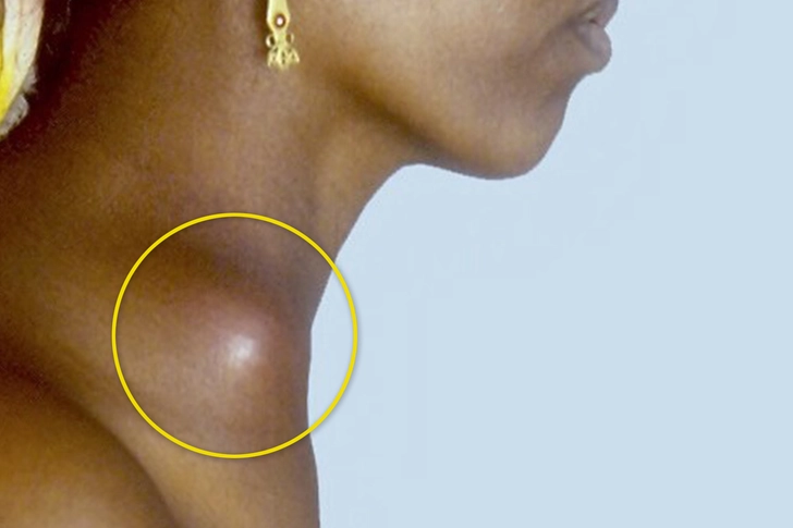 Tuberculosis