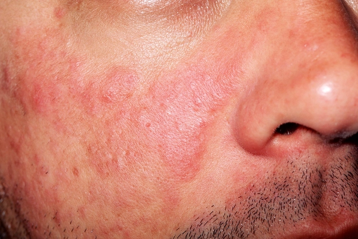 Lupus