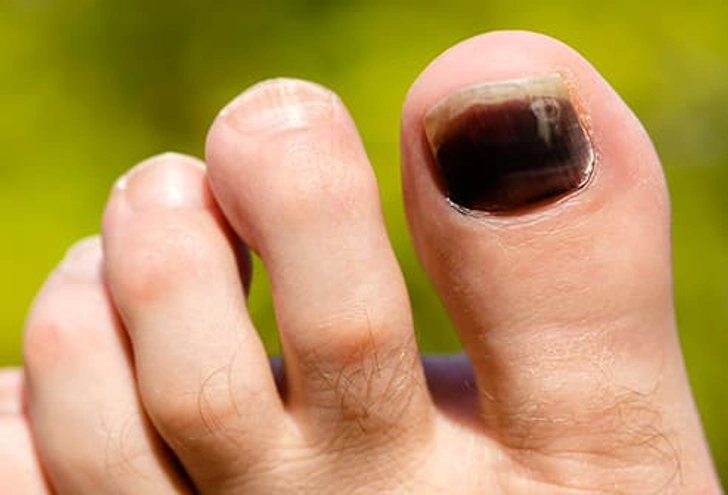 Black Toenail: Common Causes Black Toenail: Common Causes
