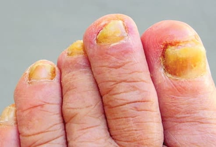 All-yellow Toenails