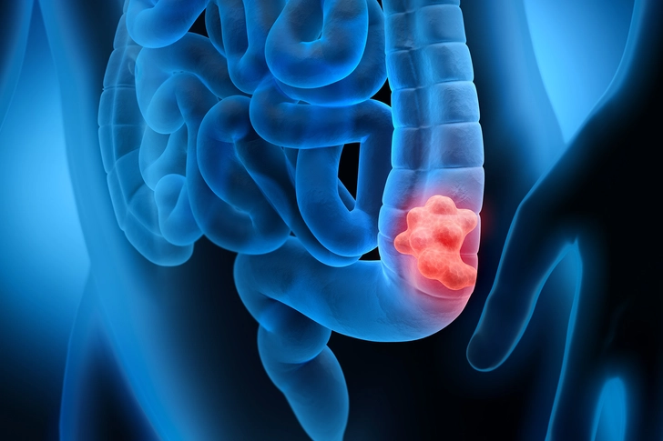 Colorectal Cancer