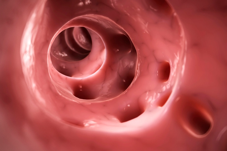 Diverticulosis/Diverticulitis