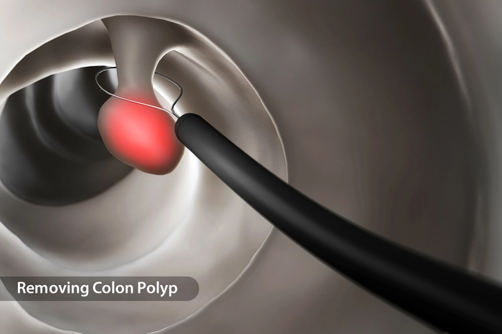 Polyps
