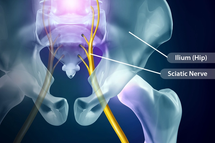 Sciatica