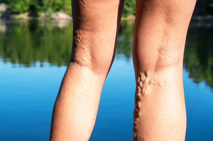 Varicose Veins