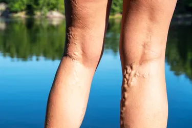 Varicose veins are bulging, sometimes bluish veins that look like cords running just beneath the surface of your?skin. They're a relatively common condition and usually affect the legs, ankles, and feet. Women are at least twice as likely as men to develop them. (Photo credit: iStock/Getty Images)