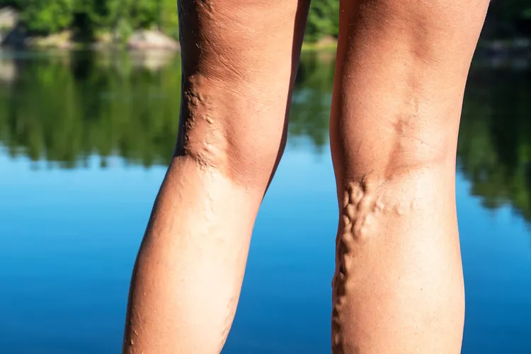 Varicose veins are bulging, sometimes bluish veins that look like cords running just beneath the surface of your skin. They're a relatively common condition and usually affect the legs, ankles, and feet. Women are at least twice as likely as men to develop them. (Photo credit: iStock/Getty Images)