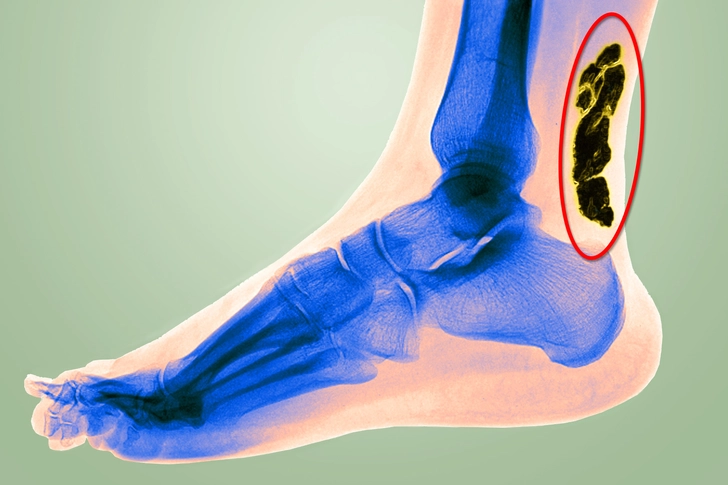 Achilles Tendinitis