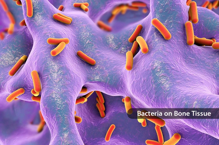 Bone Infection