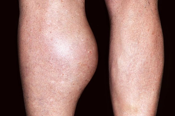 Baker's Cyst