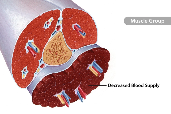 Chronic Compartment Syndrome
