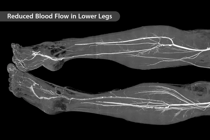 Claudication
