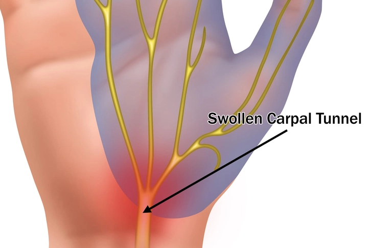 Carpal Tunnel Syndrome