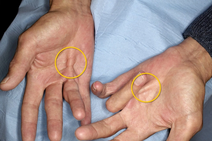 Dupuytren's Contracture Dupuytren's Contracture