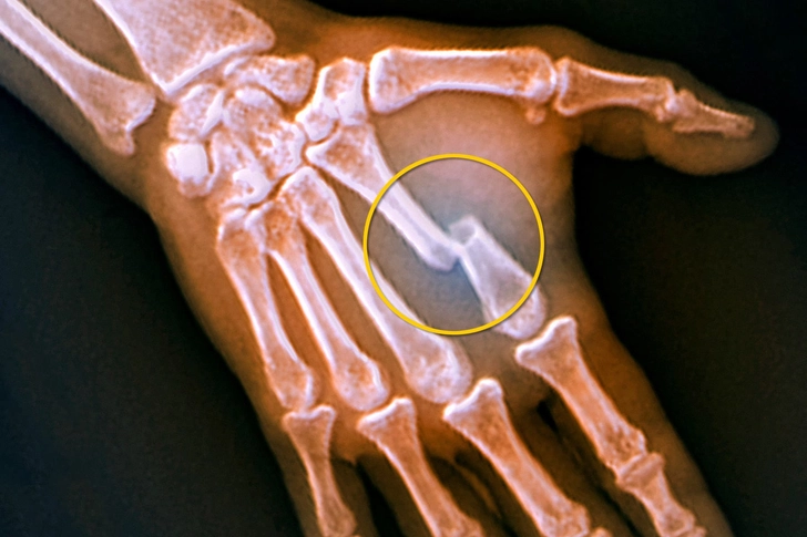 Fracture