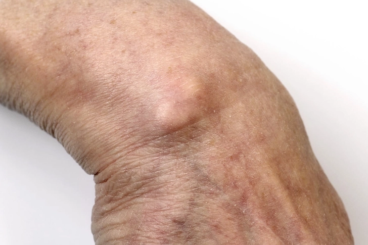 Ganglion Cyst