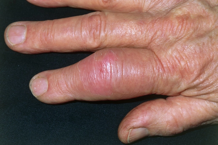 Gout