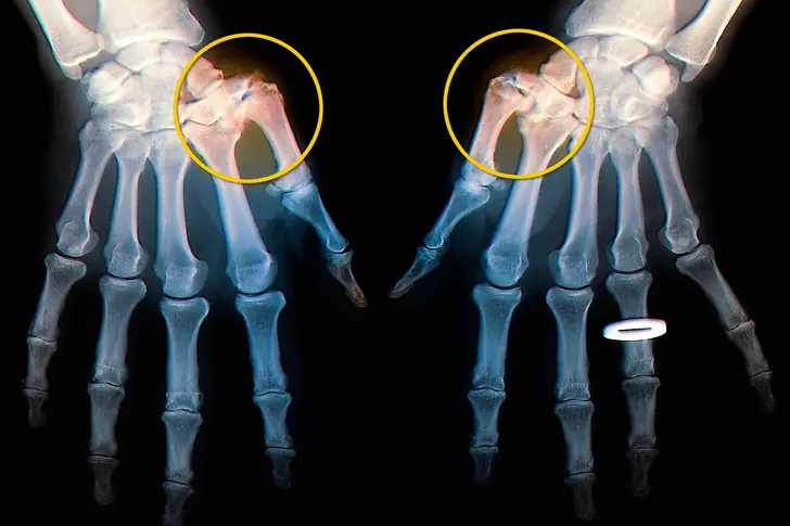 Osteoarthritis