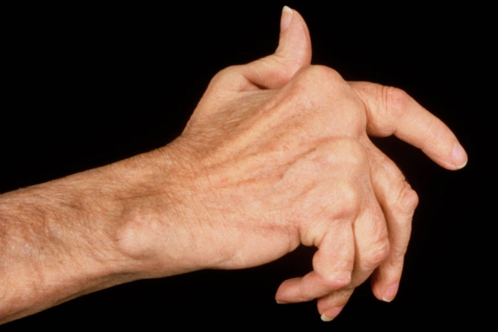 Rheumatoid Arthritis