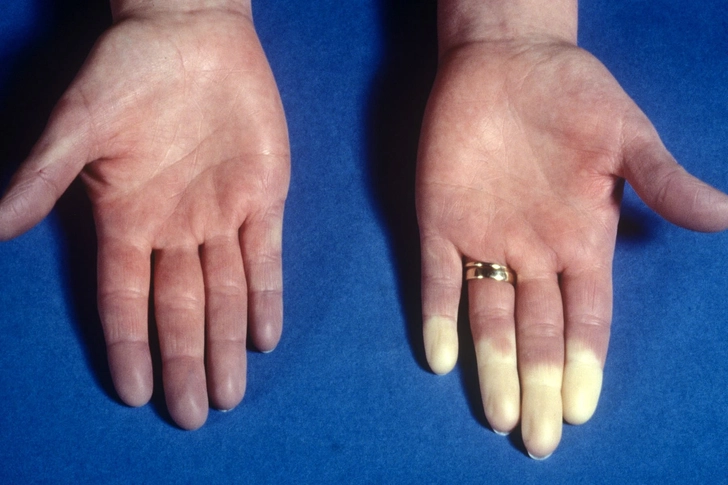Raynaud's Phenomenon