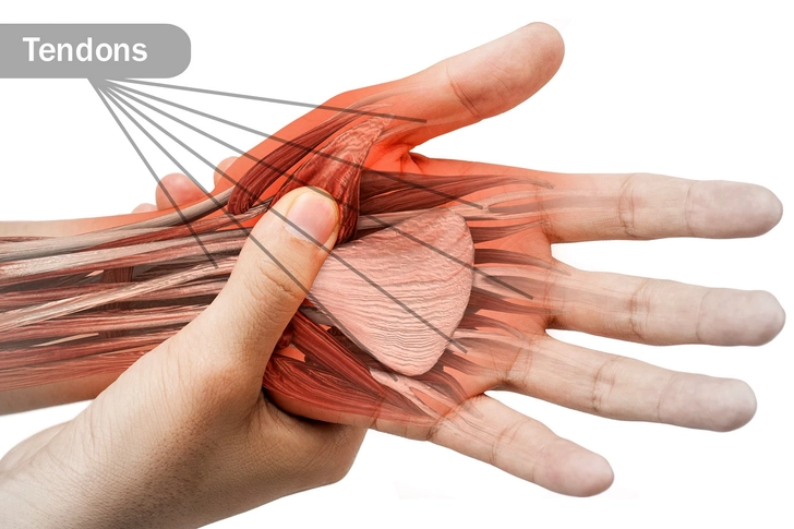 Tendinitis