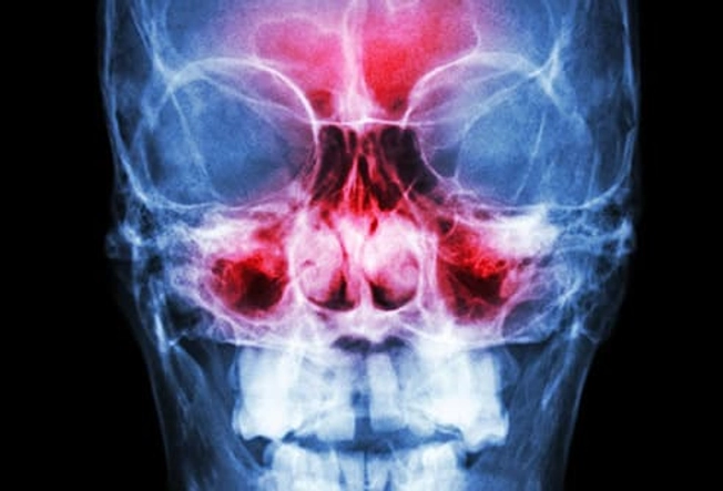 Your Sinuses Are Swollen Your Sinuses Are Swollen