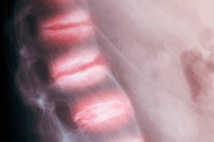 Ankylosing Spondylitis