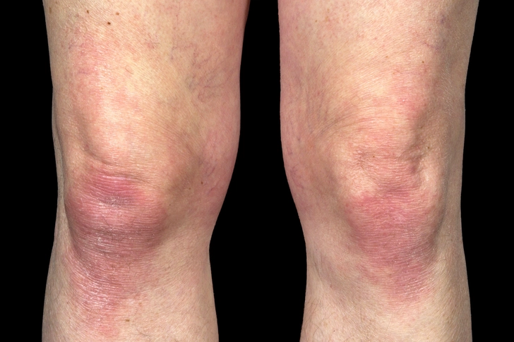 Psoriatic Arthritis