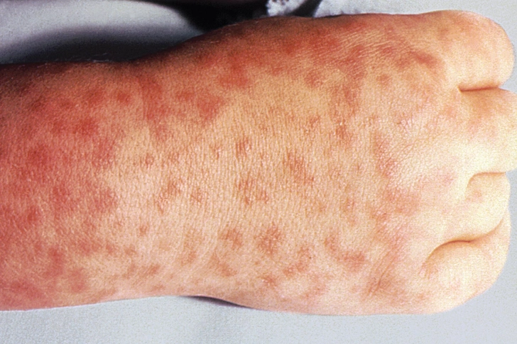 Rocky Mountain Spotted Fever