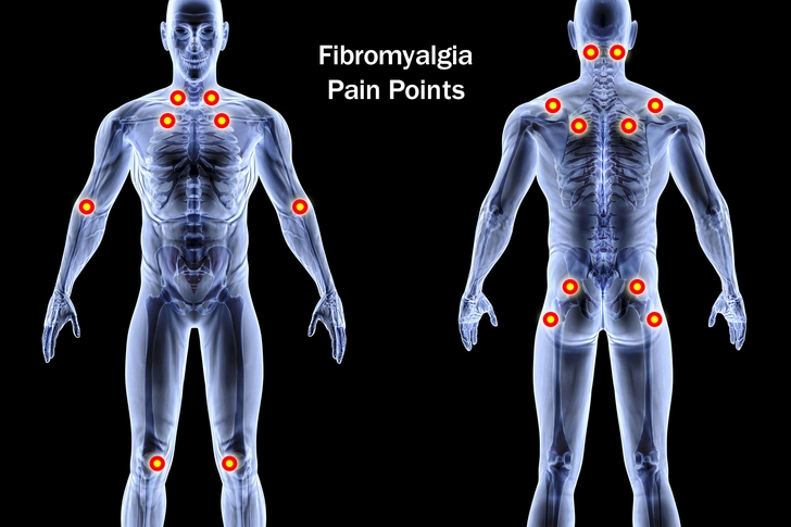 Fibromyalgia Fibromyalgia