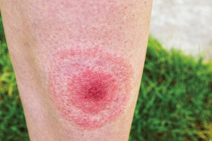 Lyme Disease
