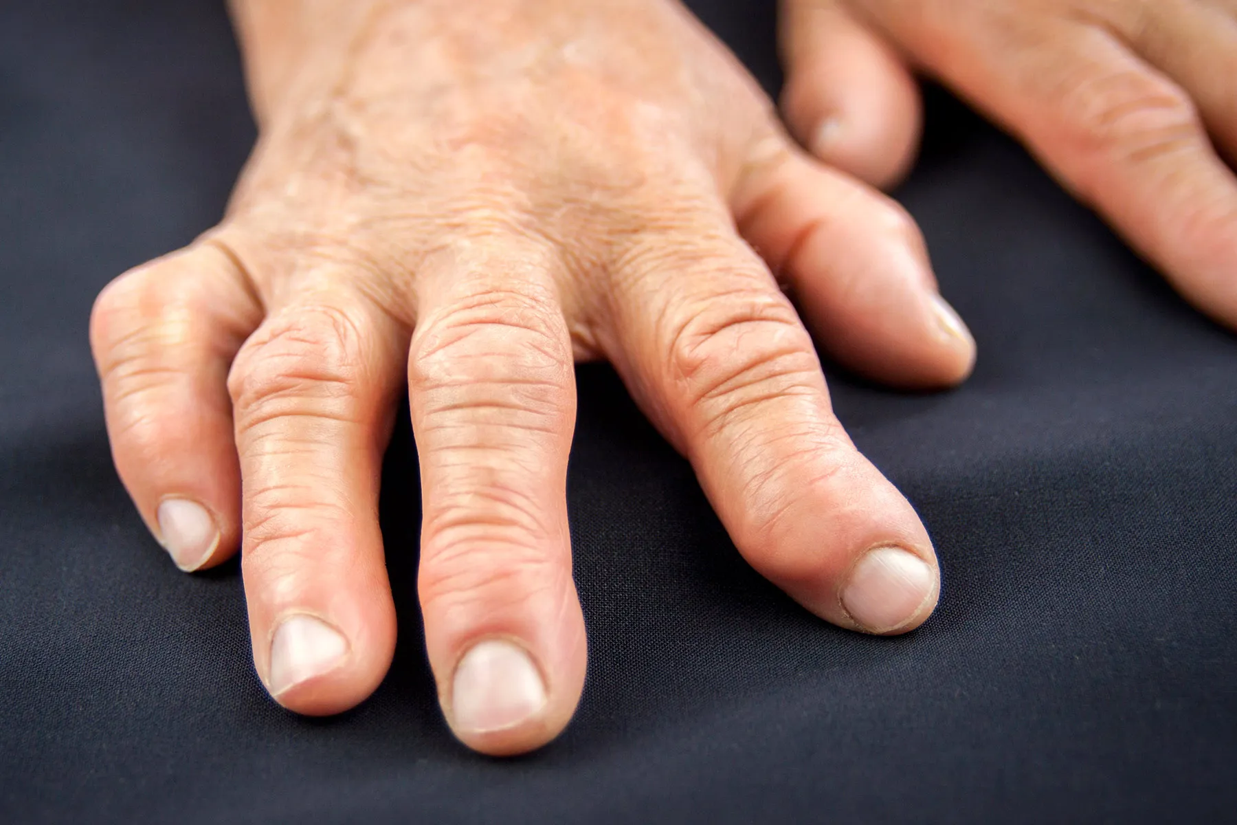 photo of rheumatoid arthritis in hands