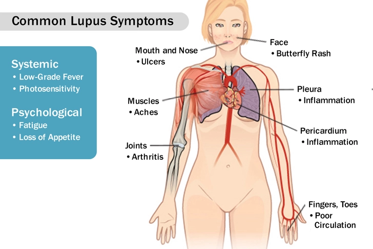 Lupus Lupus