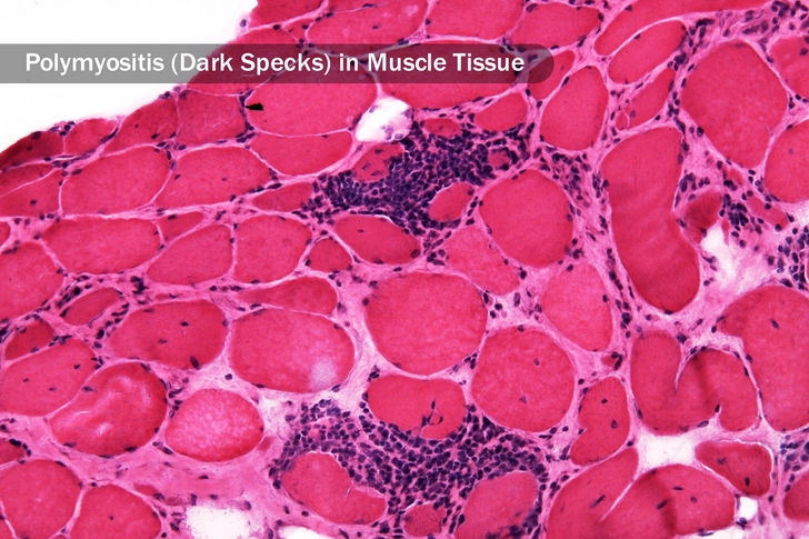 Polymyositis