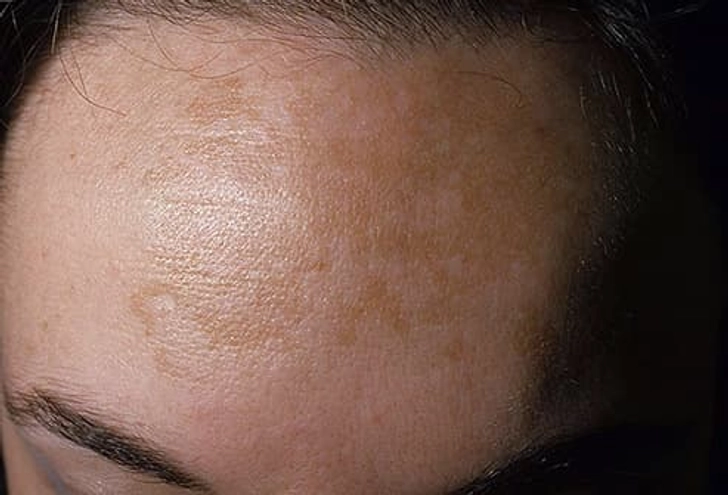 Melasma