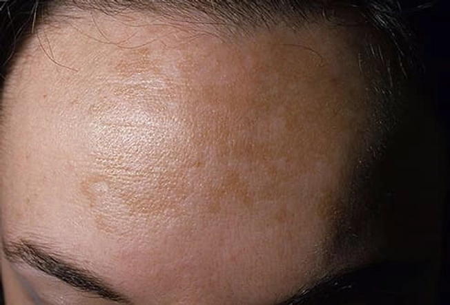Melasma Melasma