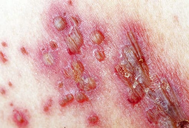 Shingles Shingles