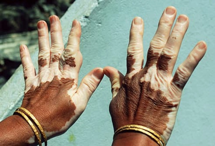 Vitiligo