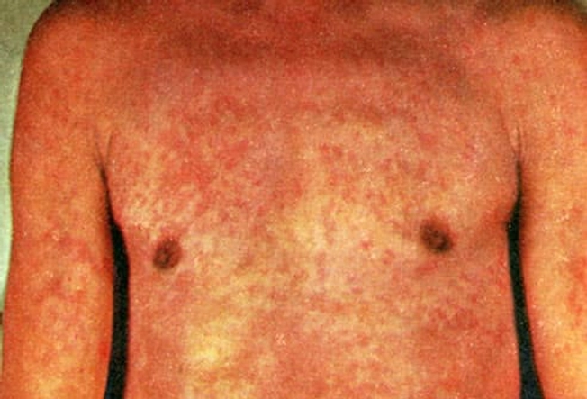 Heat Rash Heat Rash
