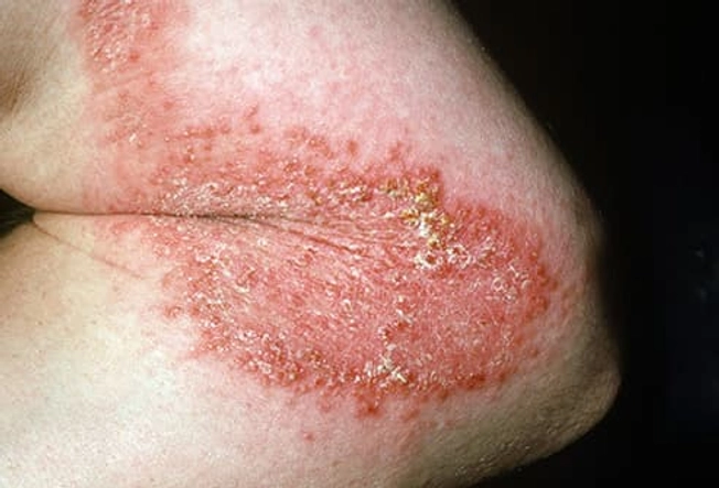 Contact Dermatitis