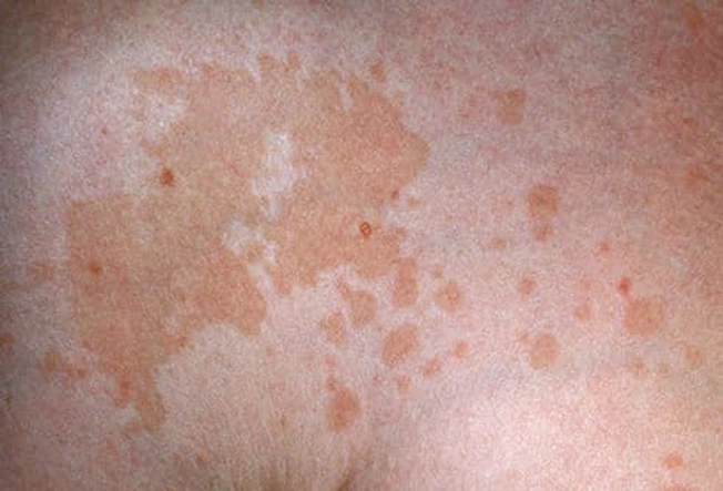 Tinea Versicolor Tinea Versicolor