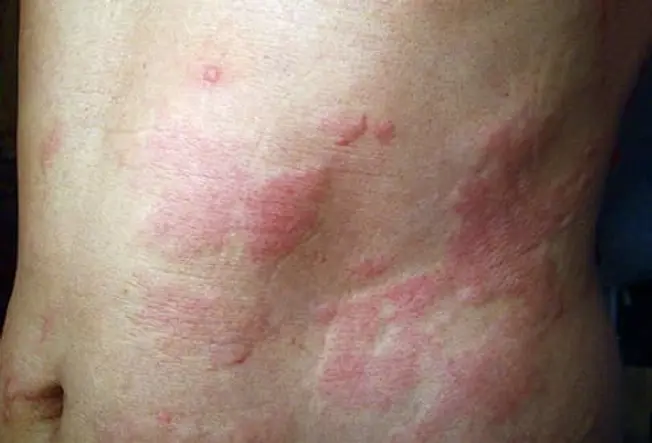 Hives Hives