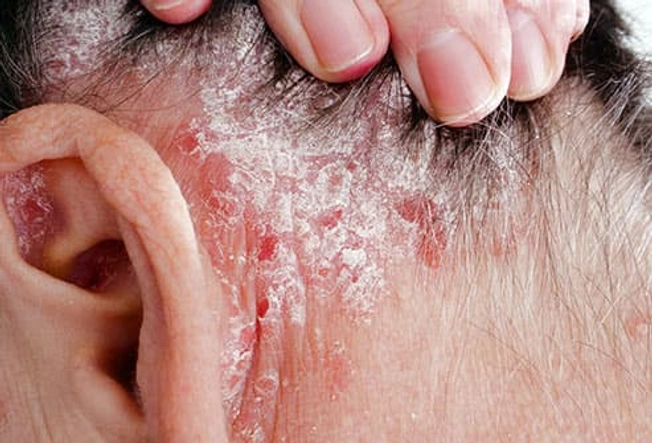 Psoriasis Psoriasis