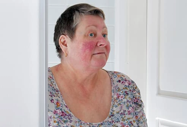 Rosacea Rosacea