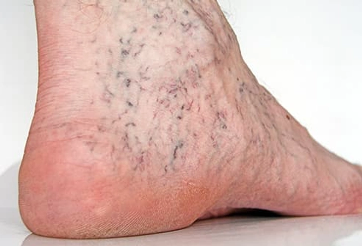Spider veins