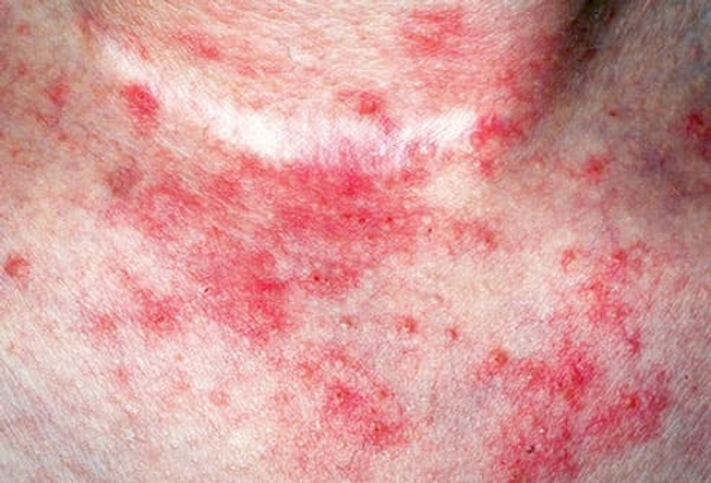 Eczema Eczema