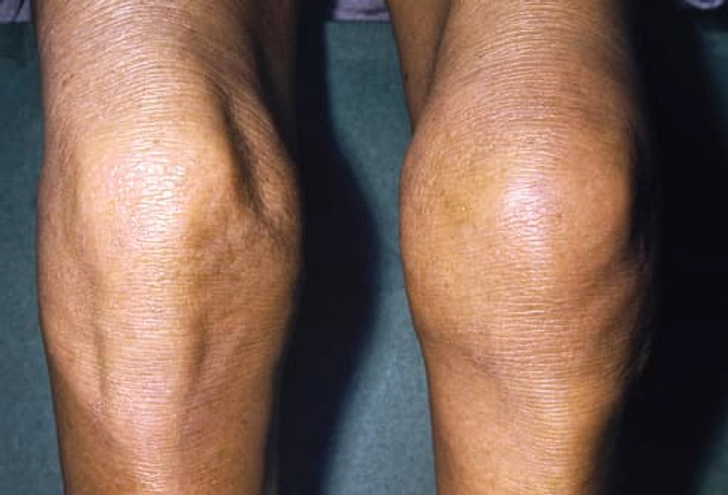 Inflammatory Arthritis
